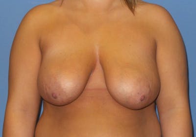 Breast Augmentation + Lift Before & After Gallery - Patient 689119 - Image 1