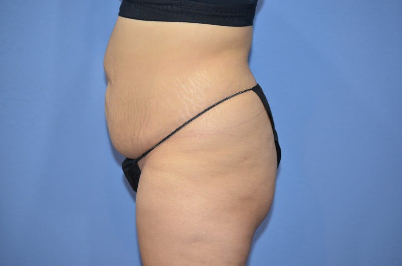 Tummy Tuck Before & After Gallery - Patient 364563 - Image 3