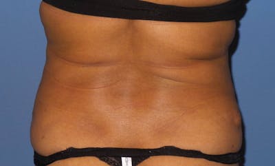 Liposuction Before & After Gallery - Patient 337293 - Image 1