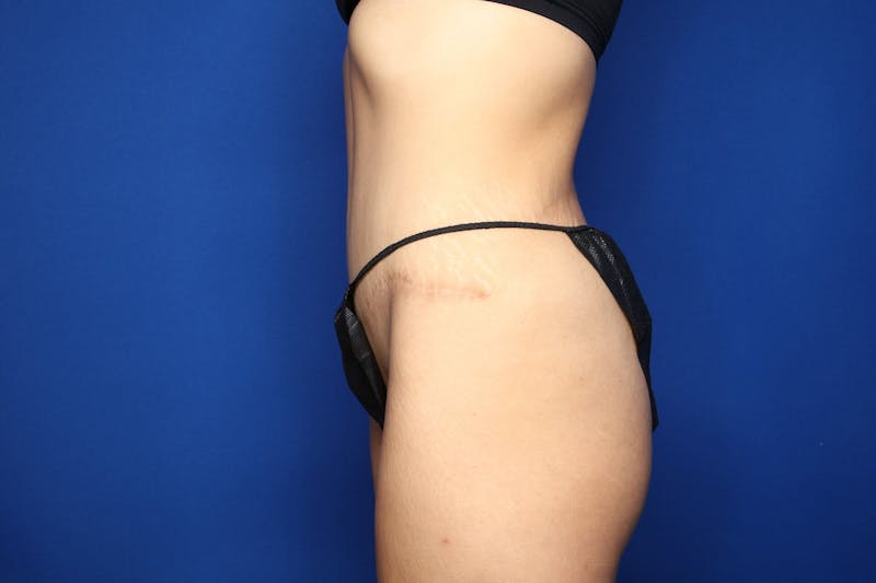 Tummy Tuck Before & After Gallery - Patient 364563 - Image 4