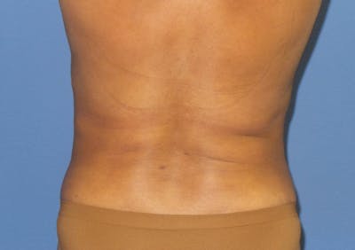 Liposuction Before & After Gallery - Patient 337293 - Image 2