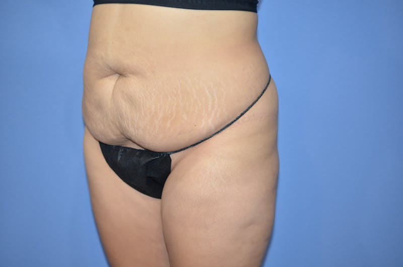 Tummy Tuck Before & After Gallery - Patient 364563 - Image 5