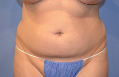 Liposuction Before & After Gallery - Patient 379599 - Image 1
