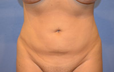 Liposuction Before & After Gallery - Patient 379599 - Image 2