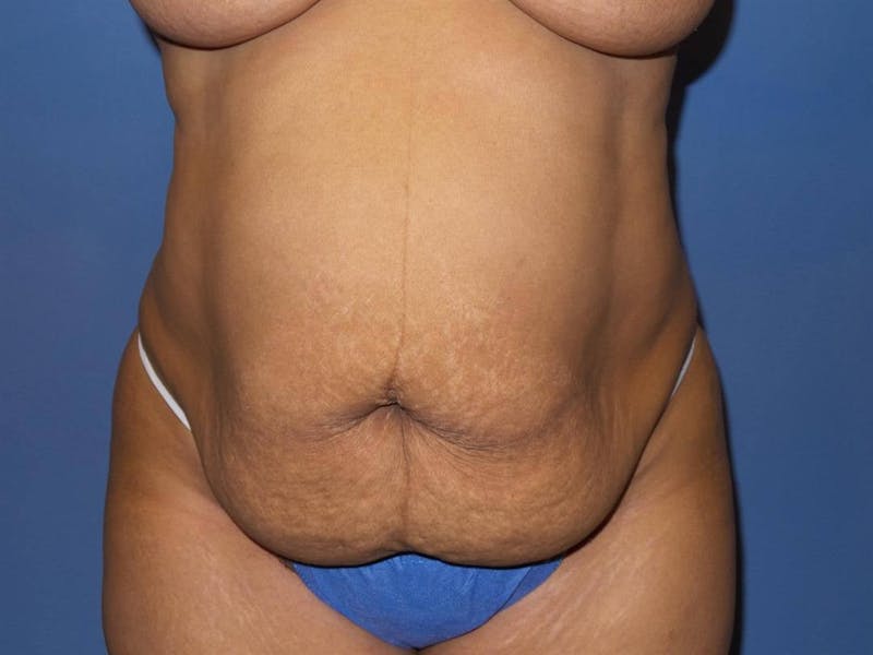 Tummy Tuck Before & After Gallery - Patient 217364 - Image 1