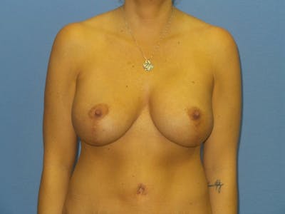 Breast Augmentation + Lift Before & After Gallery - Patient 219398 - Image 2