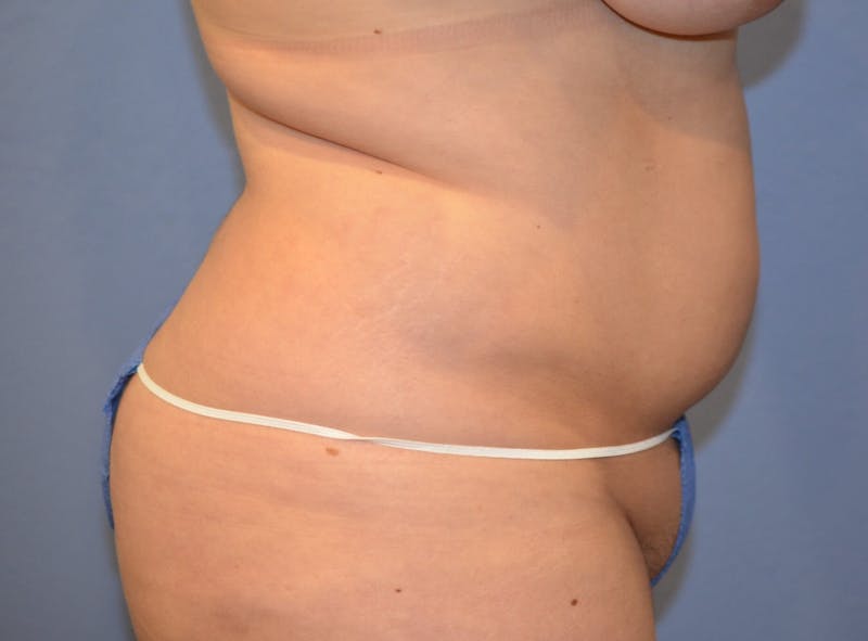 Liposuction Before & After Gallery - Patient 379599 - Image 3