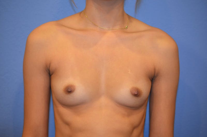 Breast Augmentation Before & After Gallery - Patient 346851 - Image 1