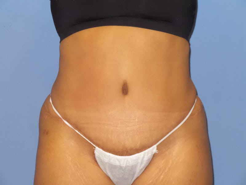 Tummy Tuck Before & After Gallery - Patient 217364 - Image 2