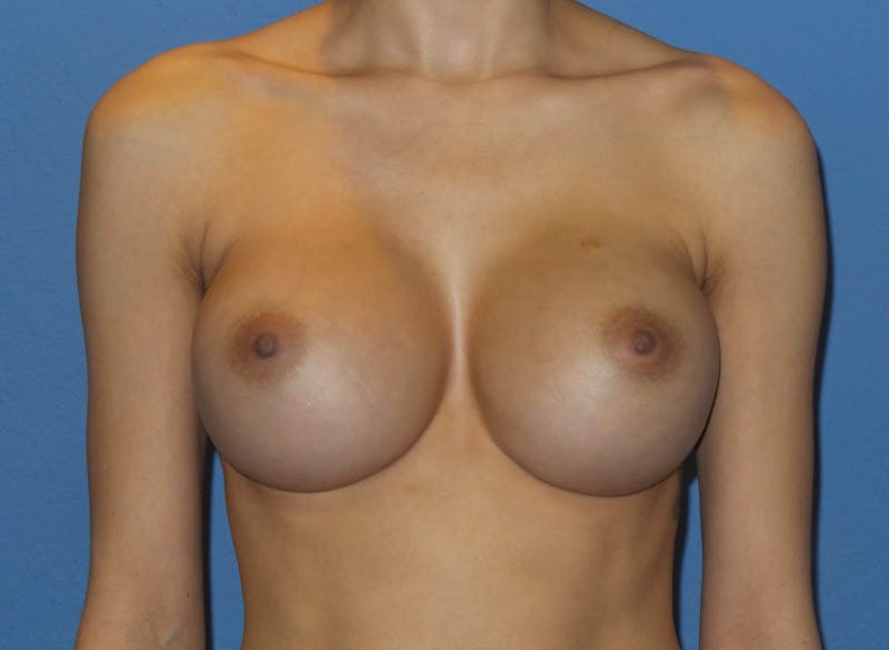 Breast Augmentation Before & After Gallery - Patient 346851 - Image 2