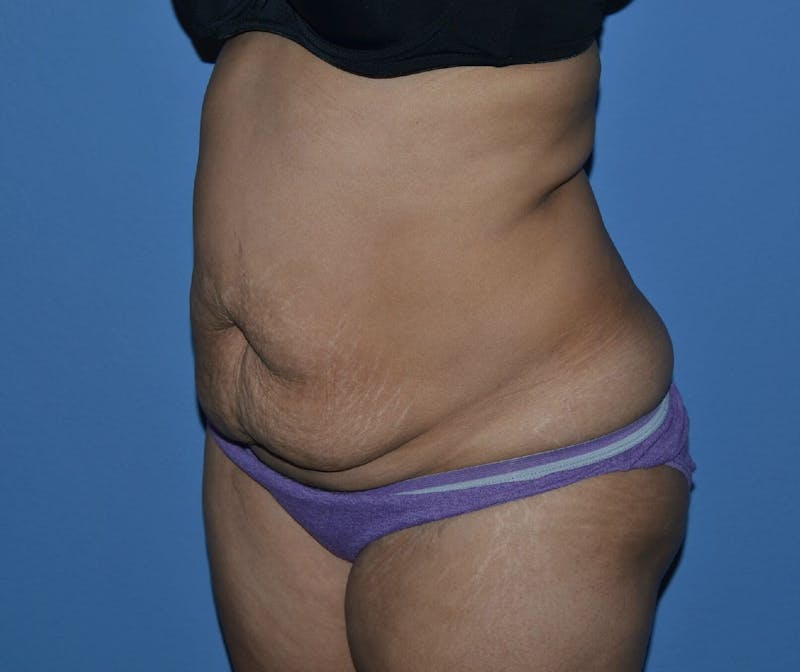 Tummy Tuck Before & After Gallery - Patient 217364 - Image 3