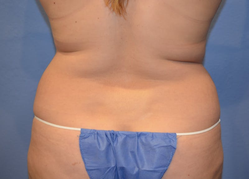 Liposuction Before & After Gallery - Patient 379599 - Image 5