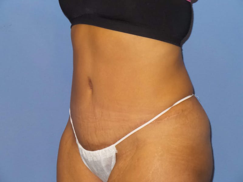 Tummy Tuck Before & After Gallery - Patient 217364 - Image 4