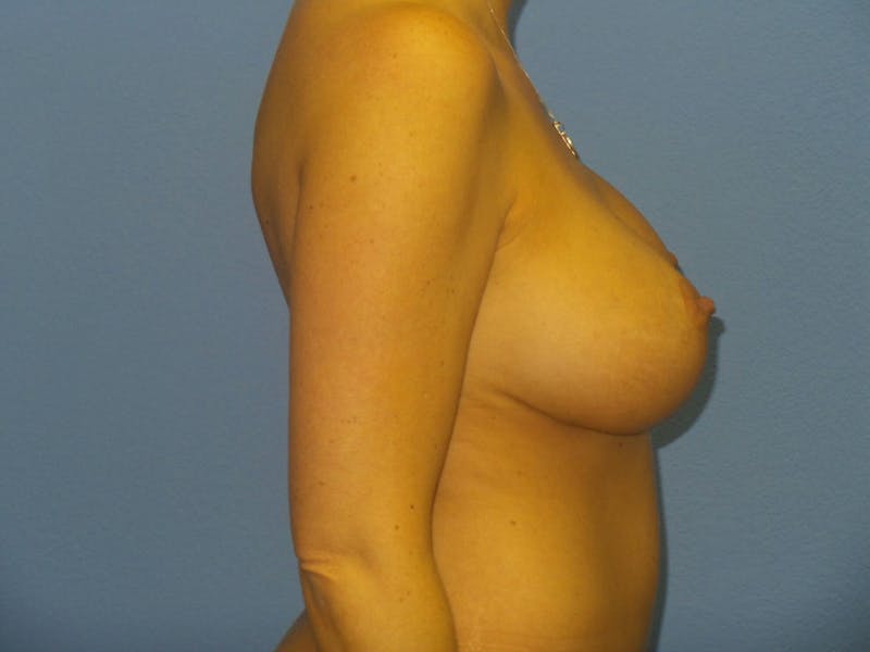 Breast Augmentation + Lift Before & After Gallery - Patient 219398 - Image 4