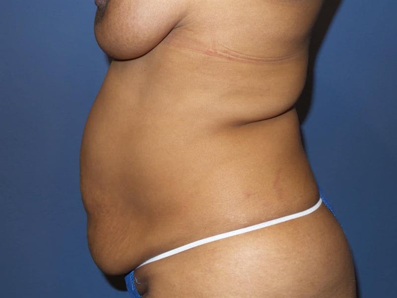 Tummy Tuck Before & After Gallery - Patient 217364 - Image 5