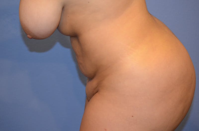 Liposuction Before & After Gallery - Patient 379599 - Image 8
