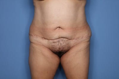 Tummy Tuck Before & After Gallery - Patient 190335 - Image 1