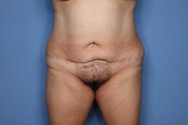 Tummy Tuck Before & After Gallery - Patient 190335 - Image 1