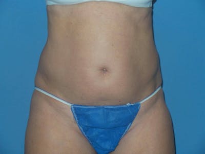 Liposuction Before & After Gallery - Patient 373722 - Image 1