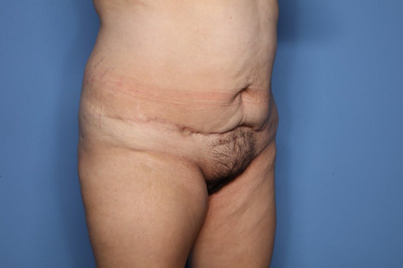 Tummy Tuck Before & After Gallery - Patient 190335 - Image 3