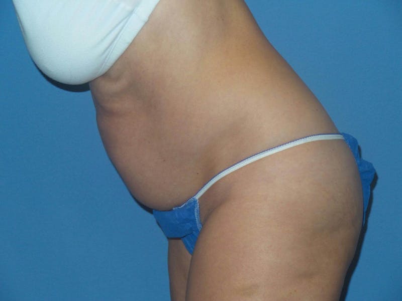 Liposuction Before & After Gallery - Patient 373722 - Image 5