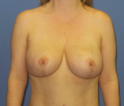 Breast Augmentation + Lift Before & After Gallery - Patient 192867 - Image 2