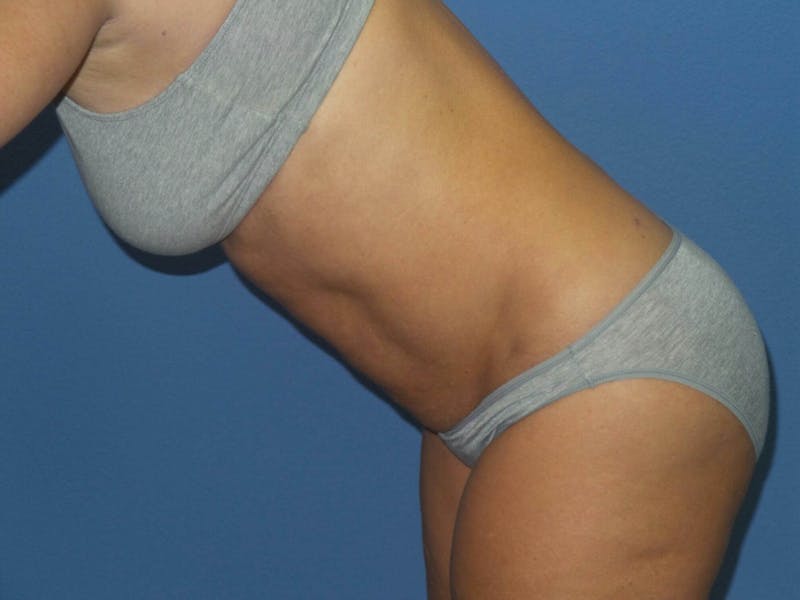 Liposuction Before & After Gallery - Patient 373722 - Image 6