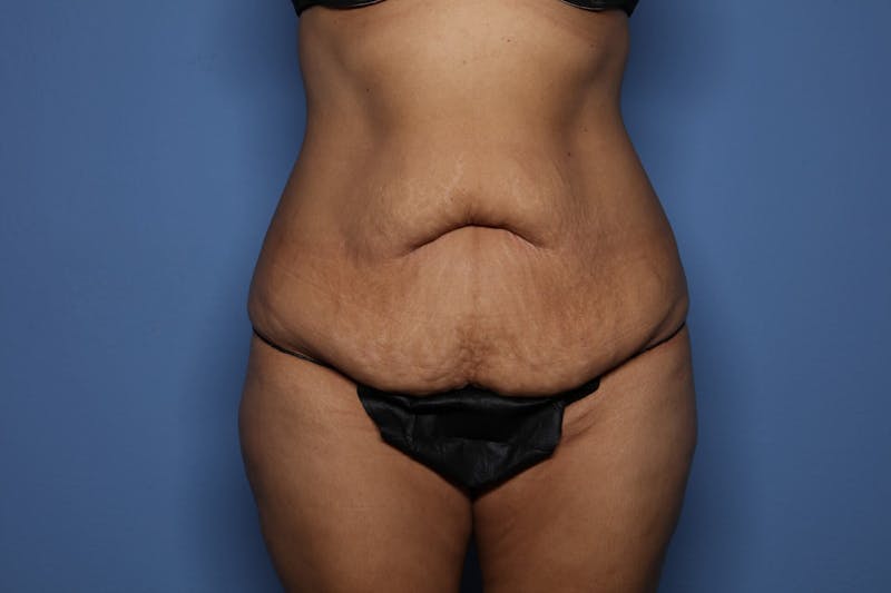Tummy Tuck Before & After Gallery - Patient 390989 - Image 1