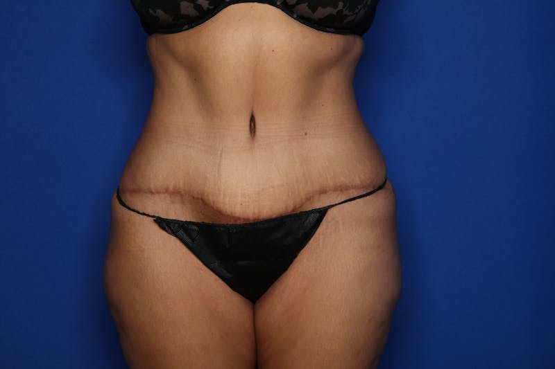 Tummy Tuck Before & After Gallery - Patient 390989 - Image 2
