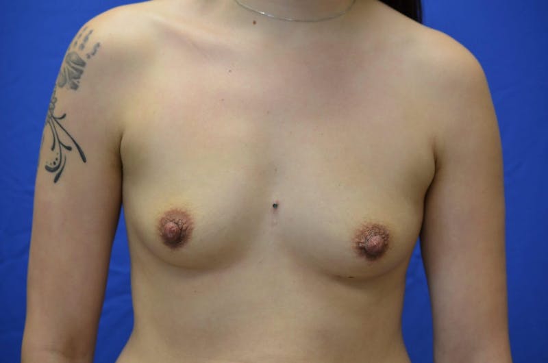 Breast Augmentation Before & After Gallery - Patient 299855 - Image 1