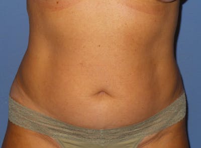 Liposuction Before & After Gallery - Patient 315210 - Image 1