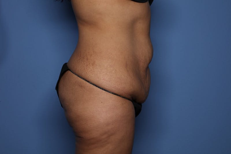 Tummy Tuck Before & After Gallery - Patient 390989 - Image 3