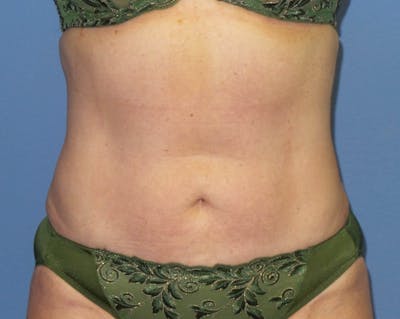 Liposuction Before & After Gallery - Patient 315210 - Image 2
