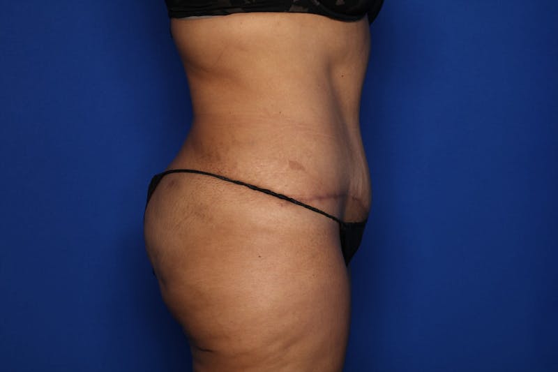 Tummy Tuck Before & After Gallery - Patient 390989 - Image 4