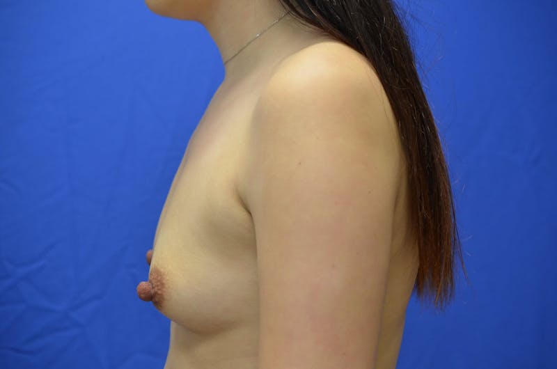 Breast Augmentation Before & After Gallery - Patient 299855 - Image 3