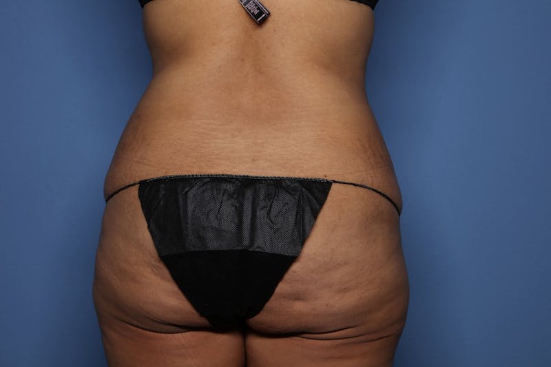 Tummy Tuck Before & After Gallery - Patient 390989 - Image 5