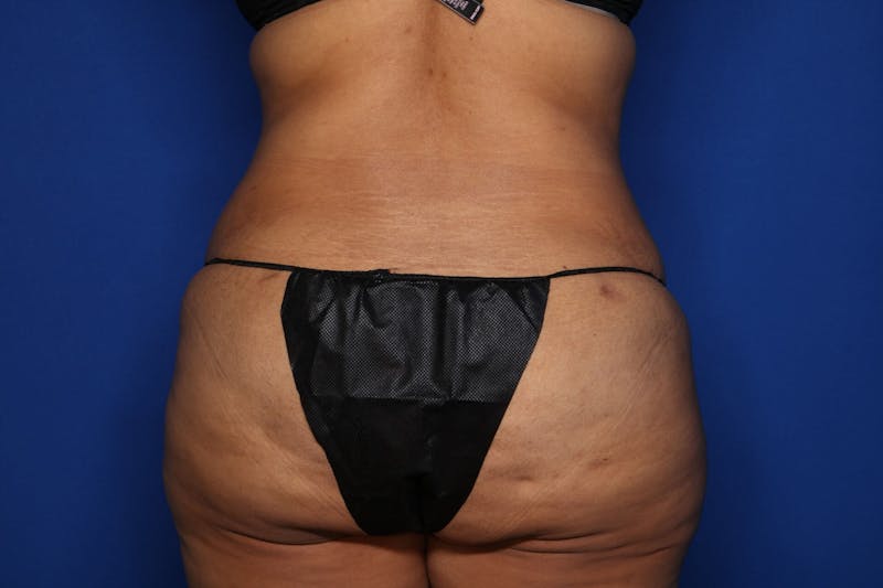 Tummy Tuck Before & After Gallery - Patient 390989 - Image 6