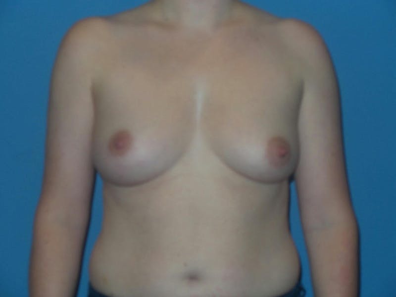 Breast Augmentation Before & After Gallery - Patient 250528 - Image 1