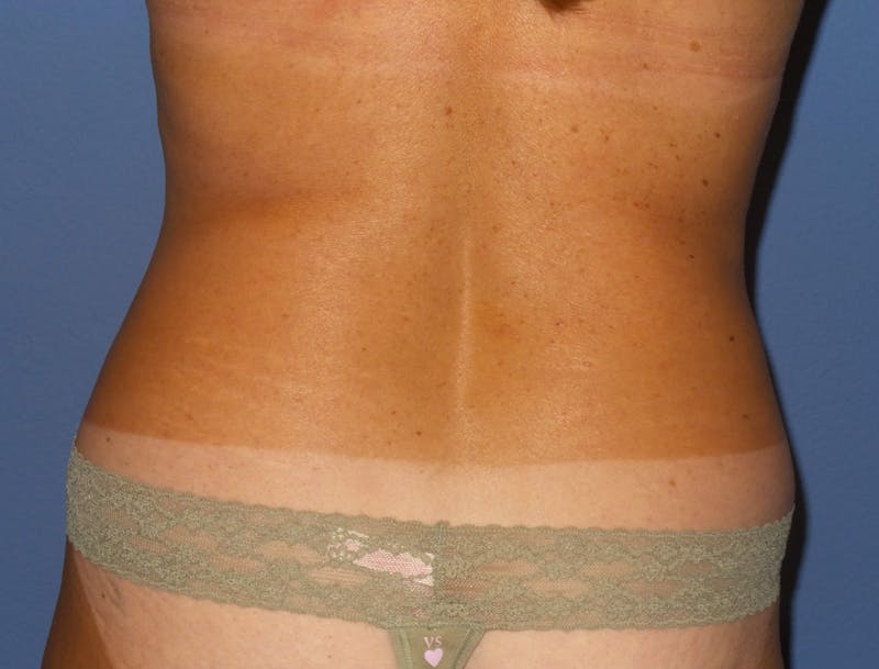 Liposuction Before & After Gallery - Patient 315210 - Image 3