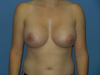 Breast Augmentation Before & After Gallery - Patient 250528 - Image 2