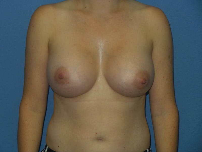 Breast Augmentation Before & After Gallery - Patient 250528 - Image 2
