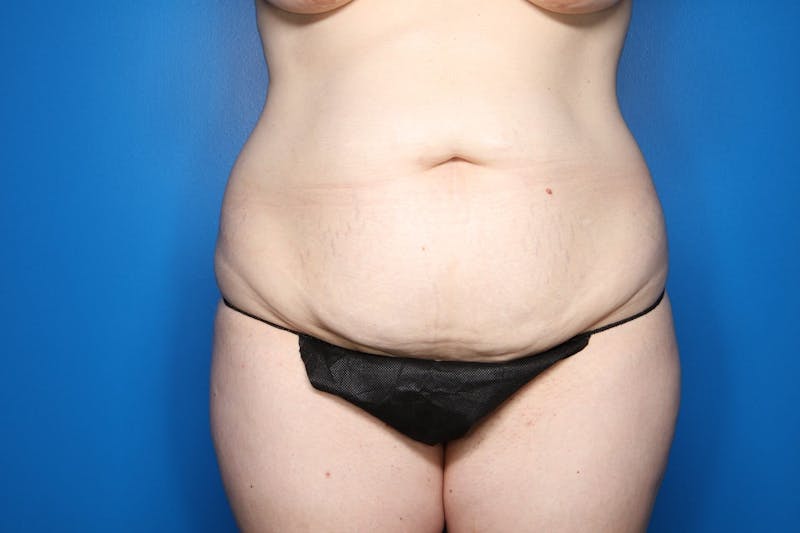 Tummy Tuck Before & After Gallery - Patient 146783 - Image 1