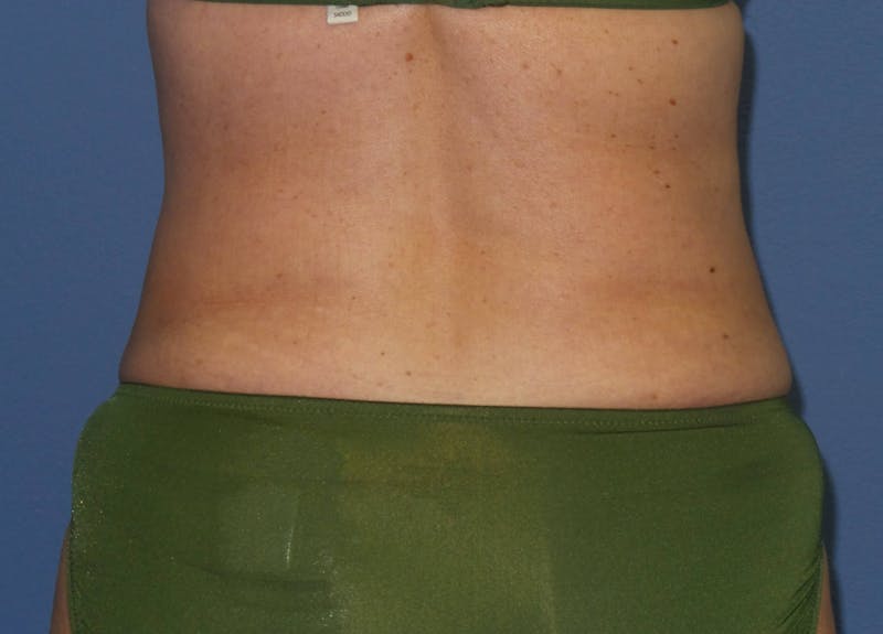 Liposuction Before & After Gallery - Patient 315210 - Image 4
