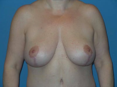 Breast Augmentation + Lift Before & After Gallery - Patient 176999 - Image 2