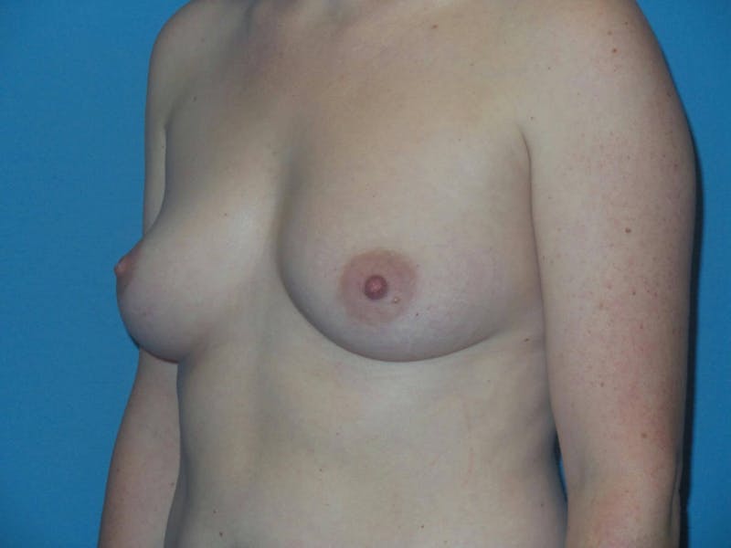 Breast Augmentation Before & After Gallery - Patient 250528 - Image 3