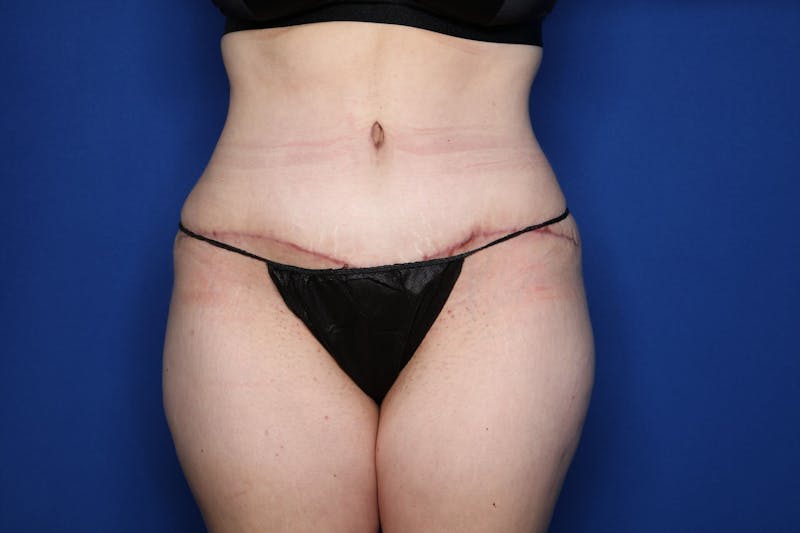 Tummy Tuck Before & After Gallery - Patient 146783 - Image 2