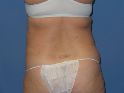 Liposuction Before & After Gallery - Patient 302089 - Image 1