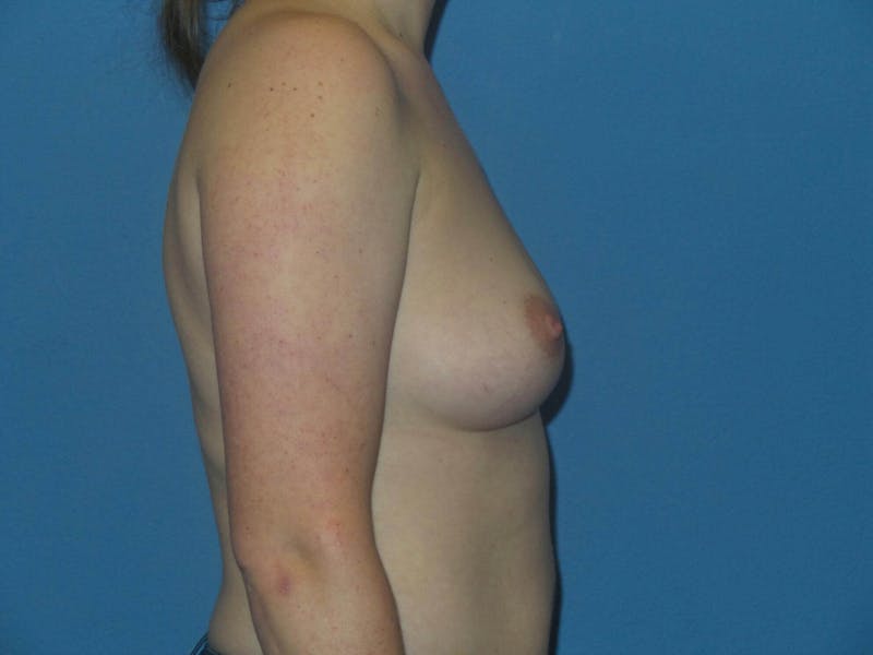 Breast Augmentation Before & After Gallery - Patient 250528 - Image 5
