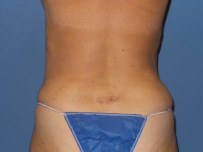 Liposuction Before & After Gallery - Patient 302089 - Image 2