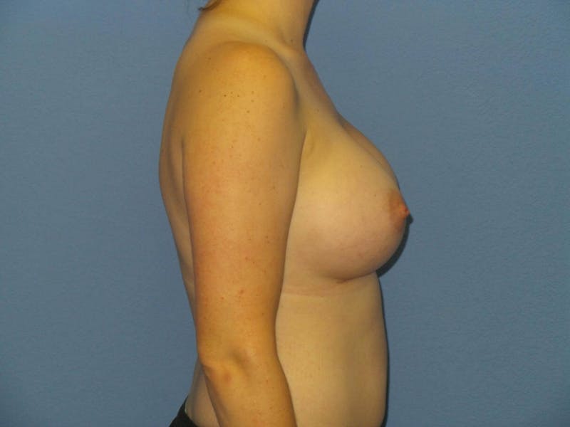 Breast Augmentation Before & After Gallery - Patient 250528 - Image 6